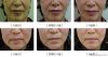 Medical facial lifting thread for plastic surgery