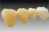 PFM denture teeth