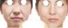 RF thermage wrinkle removal/facial lifting