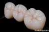 Ceramic Casting Crown,...