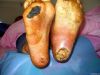 Anti infection Medicine to cure diabetic foot / heal burn wounds