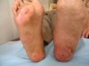 Anti infection Medicine to cure diabetic foot / heal burn wounds