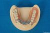 Dental removable CCP M...