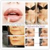 5ml/syring  cross linked hyaluronic acid dermal filler/ lip enhancer/ breast filler injection