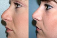 RHINOPLASTY in Chandigarh @SNOHOSPITAL