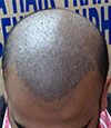 Hair Transplant for Male Pattern Baldness in India 