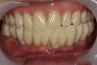 Dental implant zirconia crown and bridge dental supplies