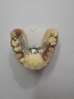 dental complete cast partial dentures supplies
