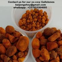 Gallstone