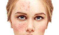 Acne Treatment With Laser Process