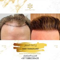 Hair Transplant