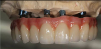 Dental Implant Lab ï¼ŒMYY Dental Lab China