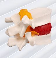 Lumbar disc herniation demonstration model