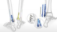 ORTHOPEDIC IMPLANTS Manu.from INDIA { dedania AT gmail DOT com }