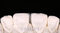e.max Veneers for Lifelike Translucency &amp;amp;amp;amp;amp; Durability  CAD/CAM Veneers | Zero Remakes, Guaranteed Fit