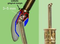 free angled implant driver