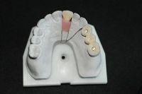 Implant Teeth