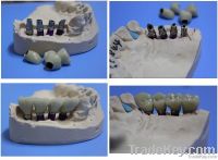 Dental implant PFM crown