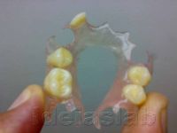 Flexible Dentures Resin PPflex
