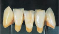 PFM Crown