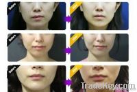 Face Lifting Thread