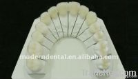 Dental full ceramic (all-porcelain) emax Crown