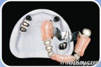 Telescopic Inner and Outer Crowns