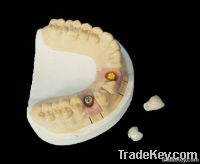 Dental Implant Prosthetics with Removable Teeth Restorations