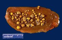 Cow Ox Gallstones