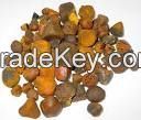 Gallstones