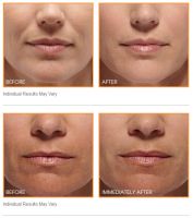 1ml Hyaluronic acid fiiler for full lips Dermal filler / Hyaluronic Acid injection