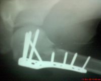 ortho imaplnts and instruments