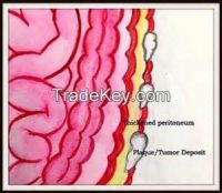 Hyperthermic intraperitoneal chemoperfusion