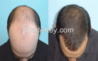 Hair Transplant in Dubai